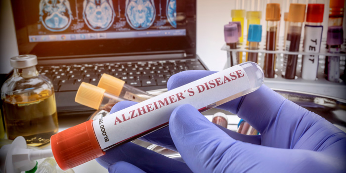 New Blood Test Can Predict Alzheimer's Disease Early